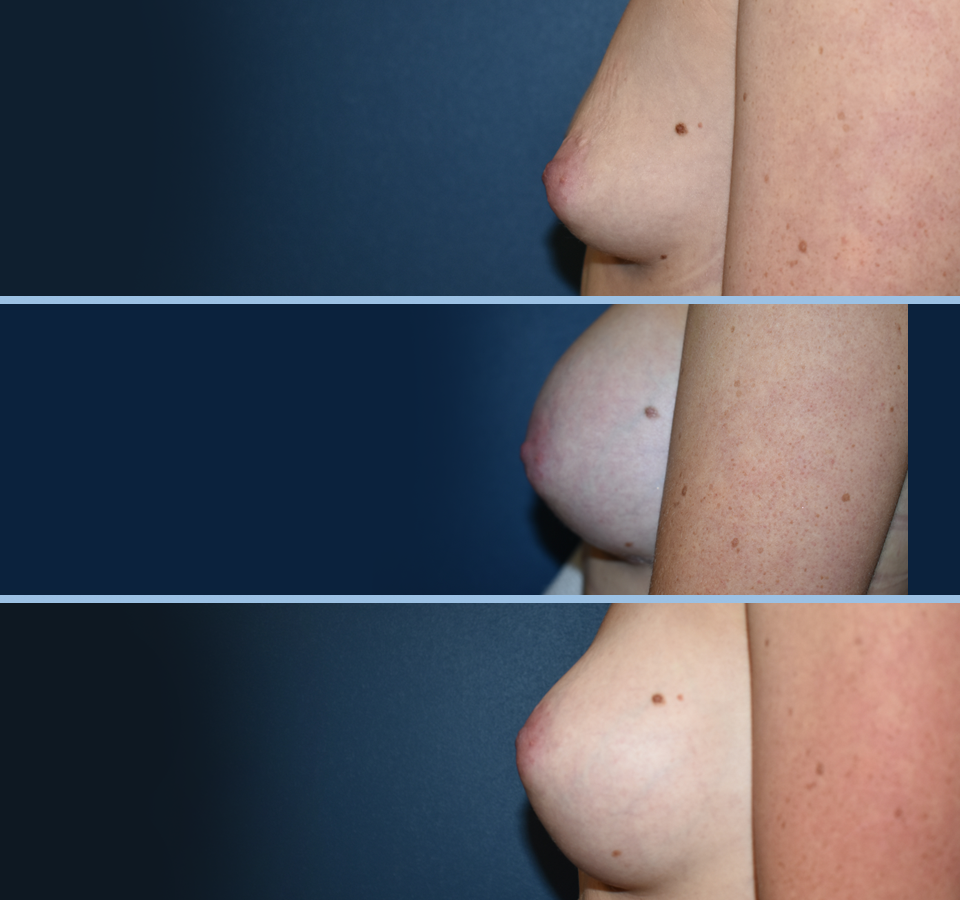 Breast Aug Pt 1 Left