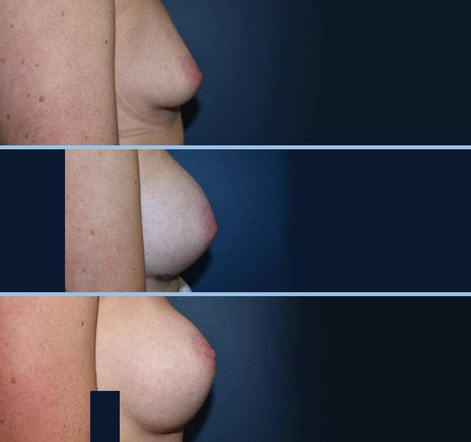 Breast Aug Pt 1 Right