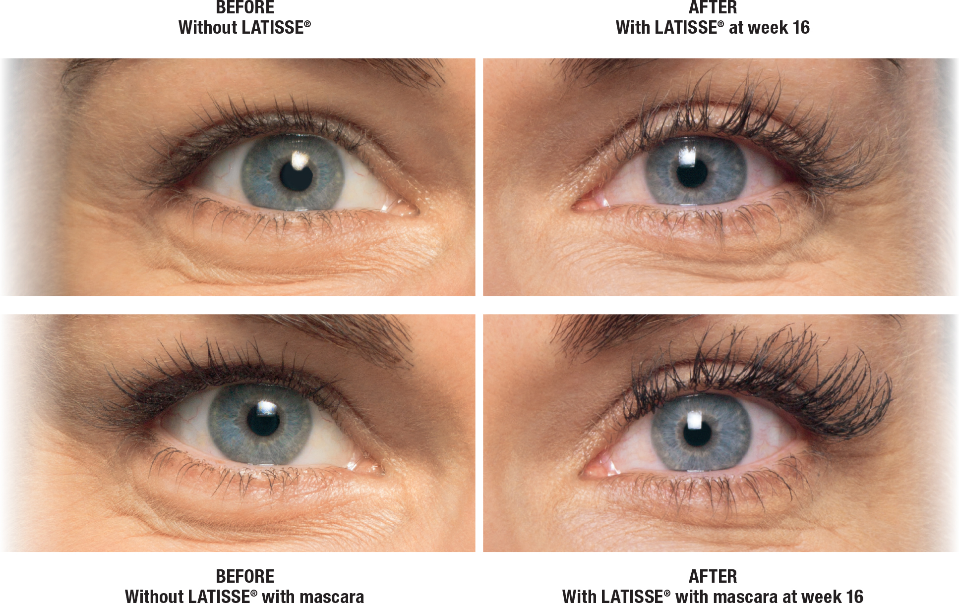 Patient eyelash before and after 1 weeks of Latisse usage