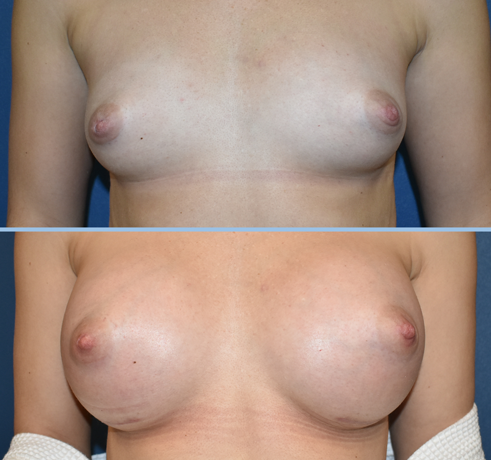 Breast Augmentation Pt 2 - Front