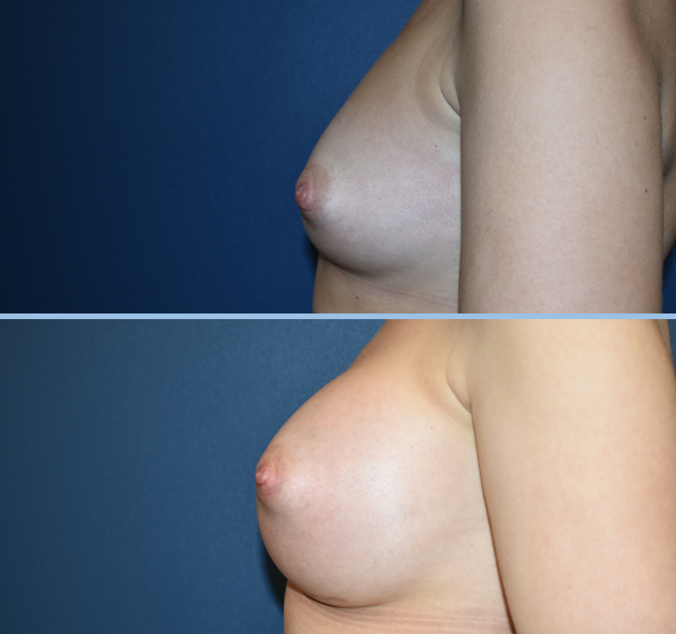 Breast Augmentation Pt 2 - Left