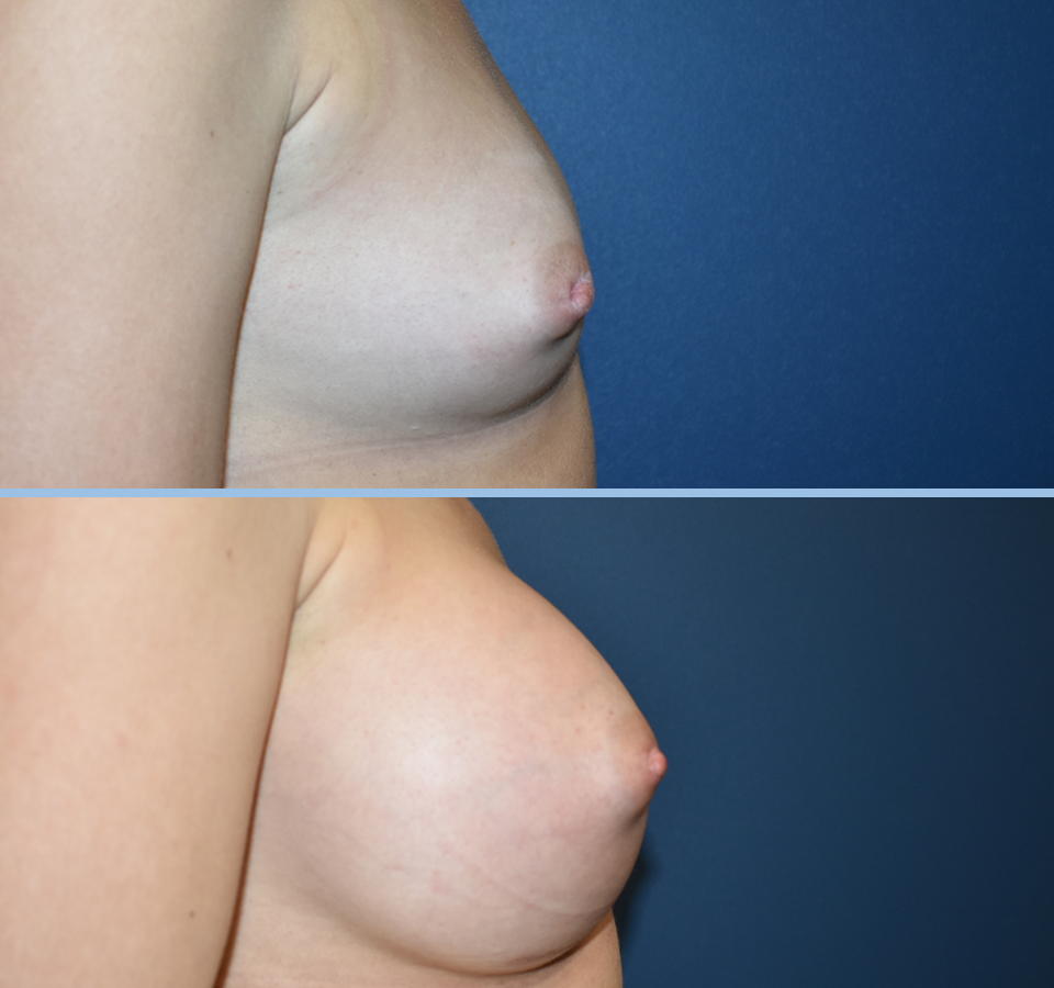 Breast Augmentation Pt 2 - Right