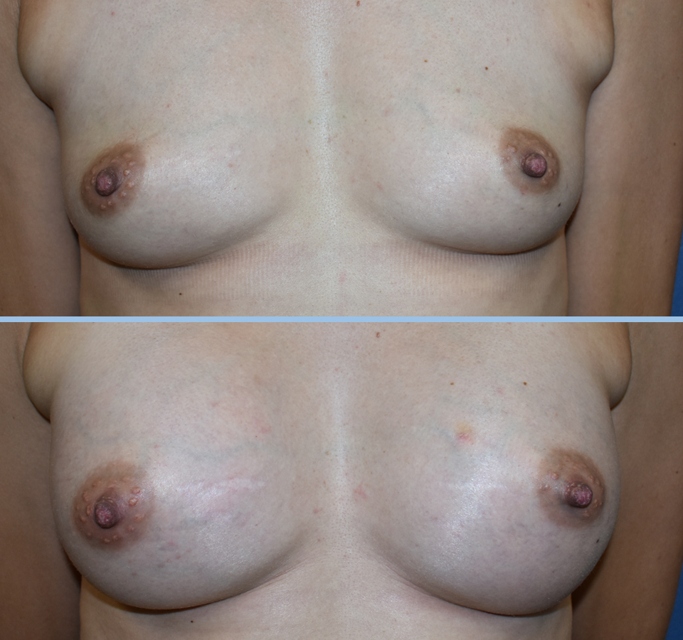 Breast Augmentation Patient 3 - Front