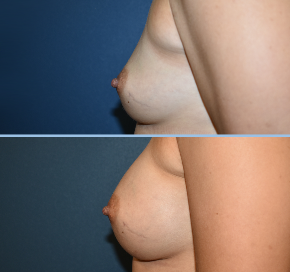 Breast Augmentation Patient 3 - Left