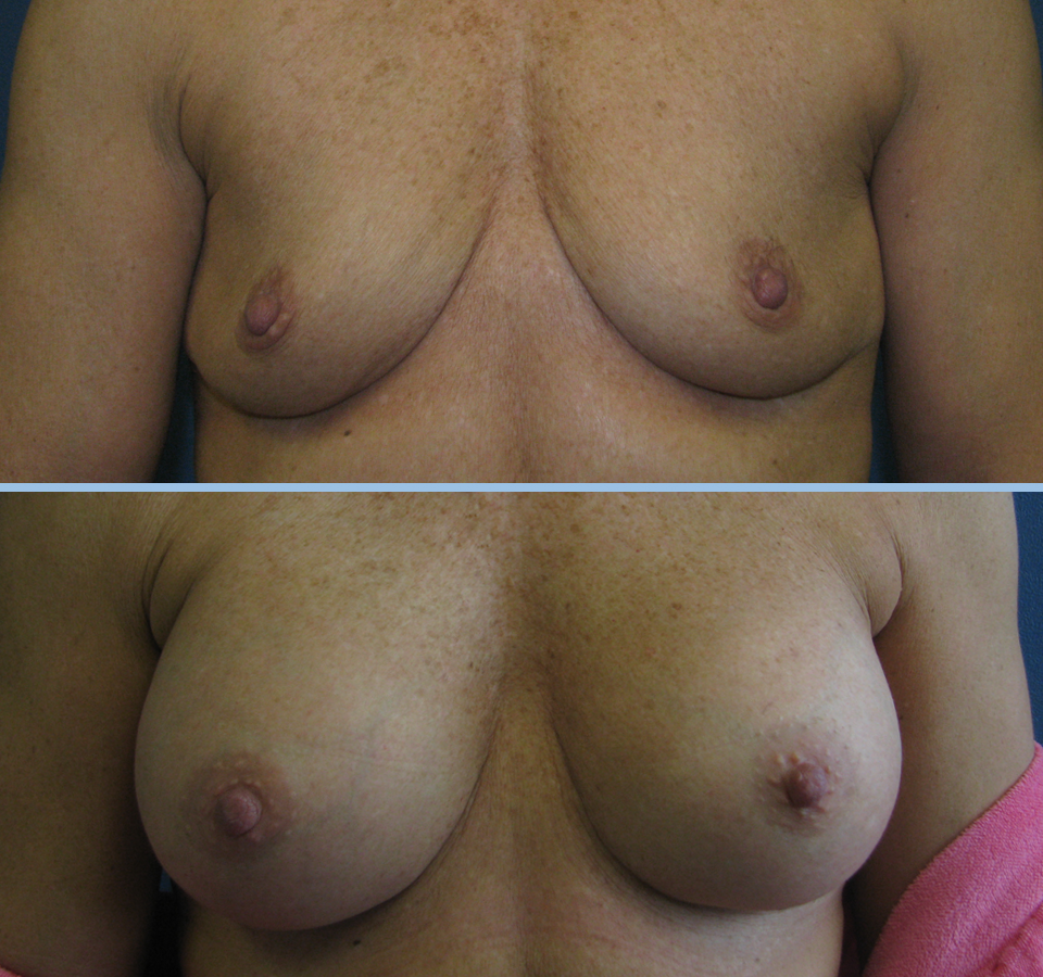 Breast Augmentation Patient 4 - Front