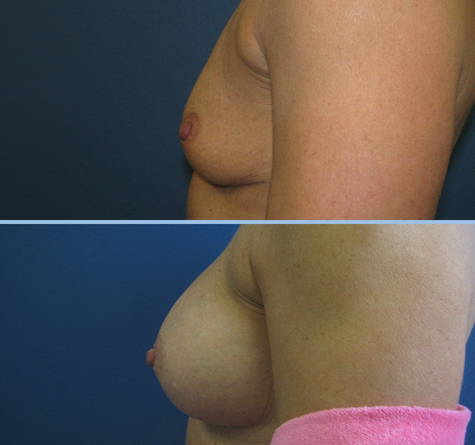Breast Augmentation Patient 4 - Left