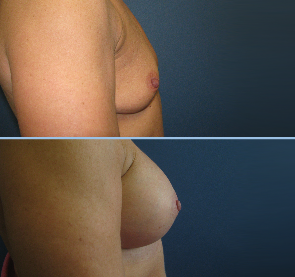 Breast Augmentation Patient 4 - Right
