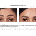 Botox Before and After - Woman - Forehead lines