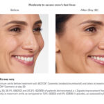 Botox Before and After - Woman - crows feet