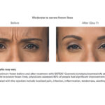 Botox Before and After - Woman - lines between brows