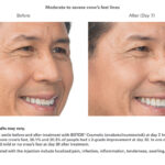 Botox Before and After - man - crows feet