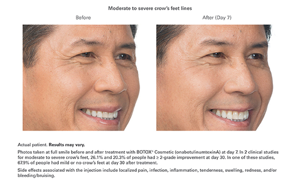 Botox Before and After - man - crows feet