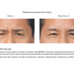 Botox Before and After - man - lines between brows