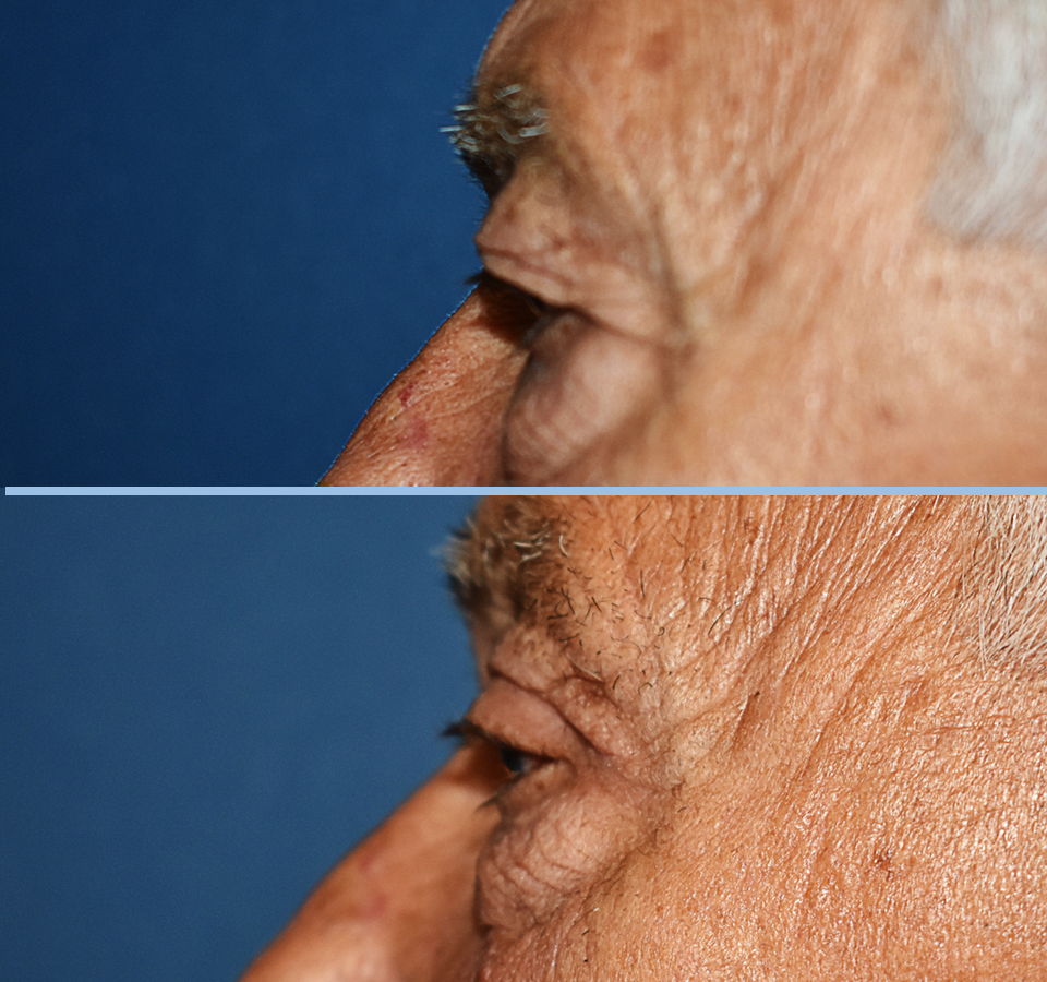 Eyelid Patient 1 Left View