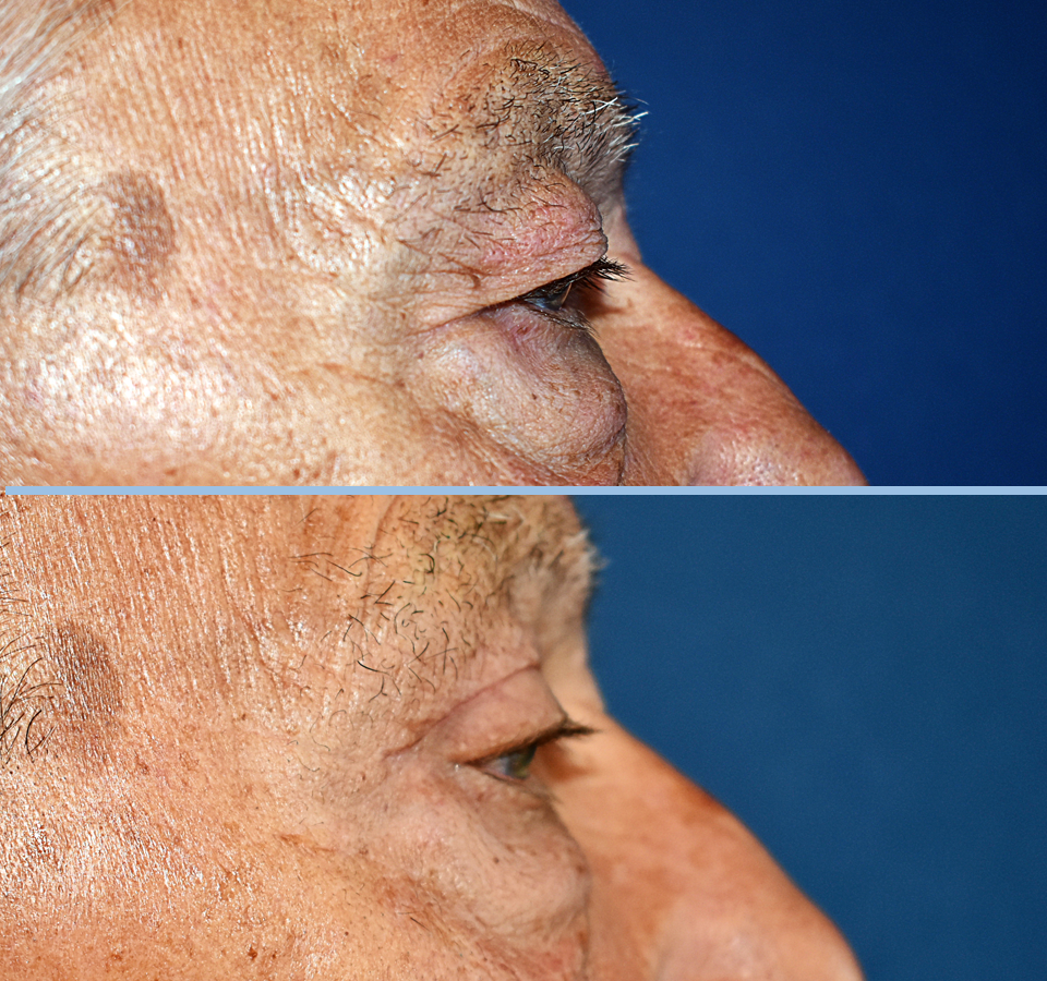 Eyelid Patient 1 Right View