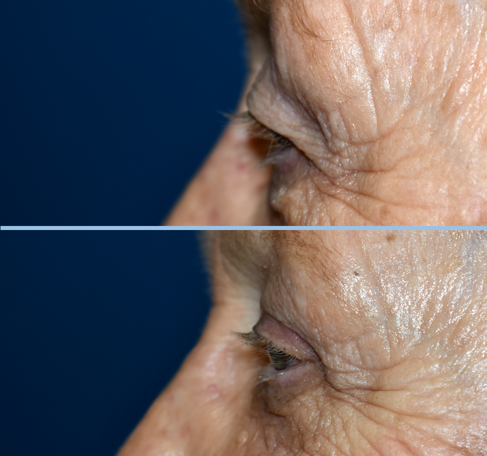 Eyelid Patient 3 Left View