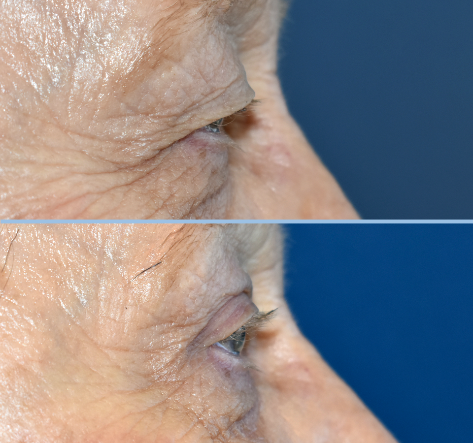 Eyelid Patient 3 Right View