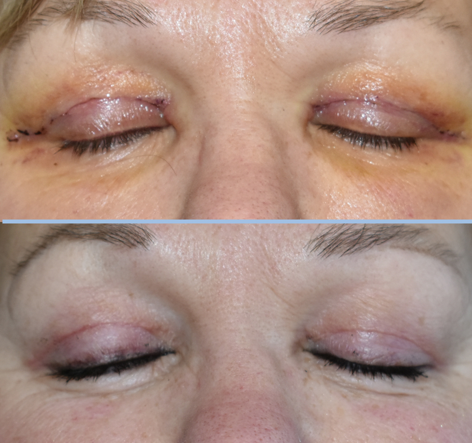 Eyelid Patient 4 Front View with Eyes Closed