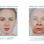 information on areas of the face that change as you age
