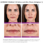 before and after photos of a woman with juvederm vobella lip injections