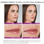 before and after photos of a woman with juvederm vobella lip injections