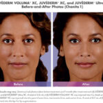 before and after of woman with juvederm voluma and ultra plus injections around mouth and cheeks