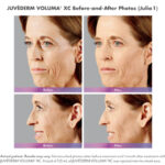 before and after of woman with juvederm voluma and ultra plus injections around mouth and cheeks