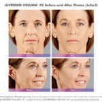 before and after of woman with juvederm voluma and ultra plus injections around mouth and cheeks