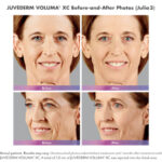 before and after of woman with juvederm voluma and ultra plus injections around mouth and cheeks