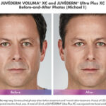 before and after of man with juvederm voluma and ultra plus injections around mouth