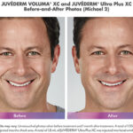 before and after of man with juvederm voluma and ultra plus injections around mouth
