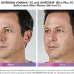 before and after of man with juvederm voluma and ultra plus injections around mouth