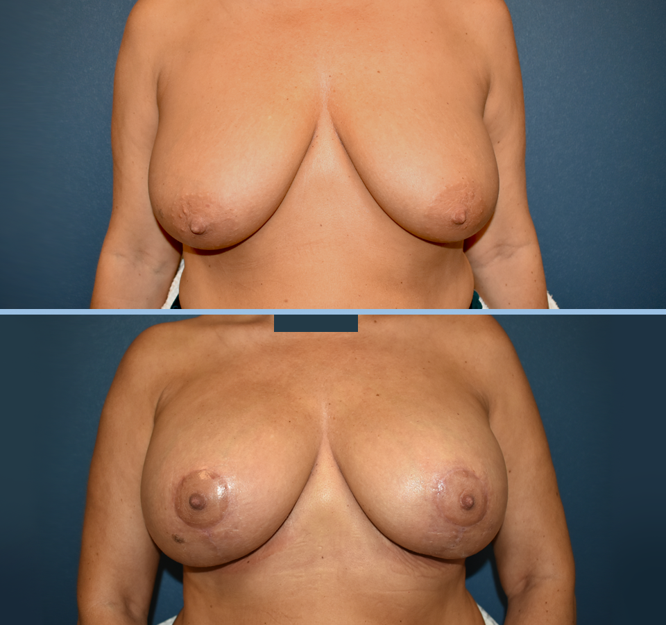 Breast Lift Patient 1 Front View