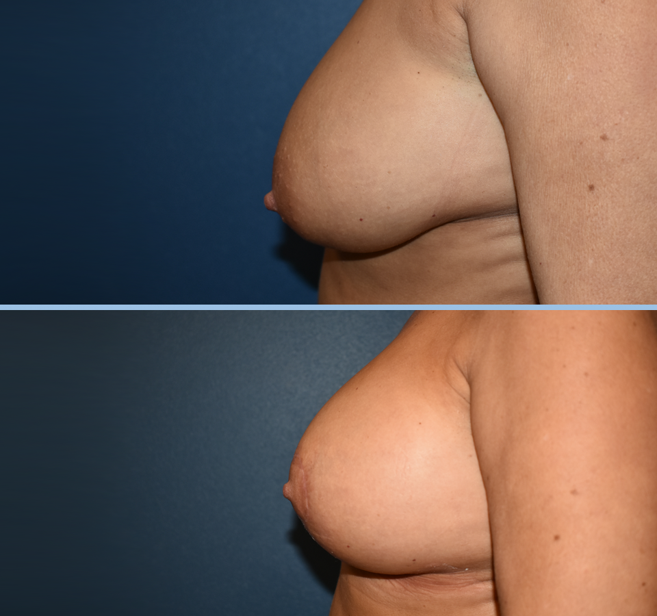 Breast Lift Patient 1 Left View