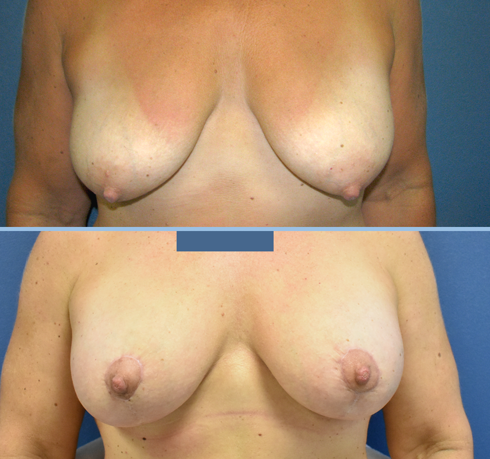 Breast Lift Patient 2 Front View