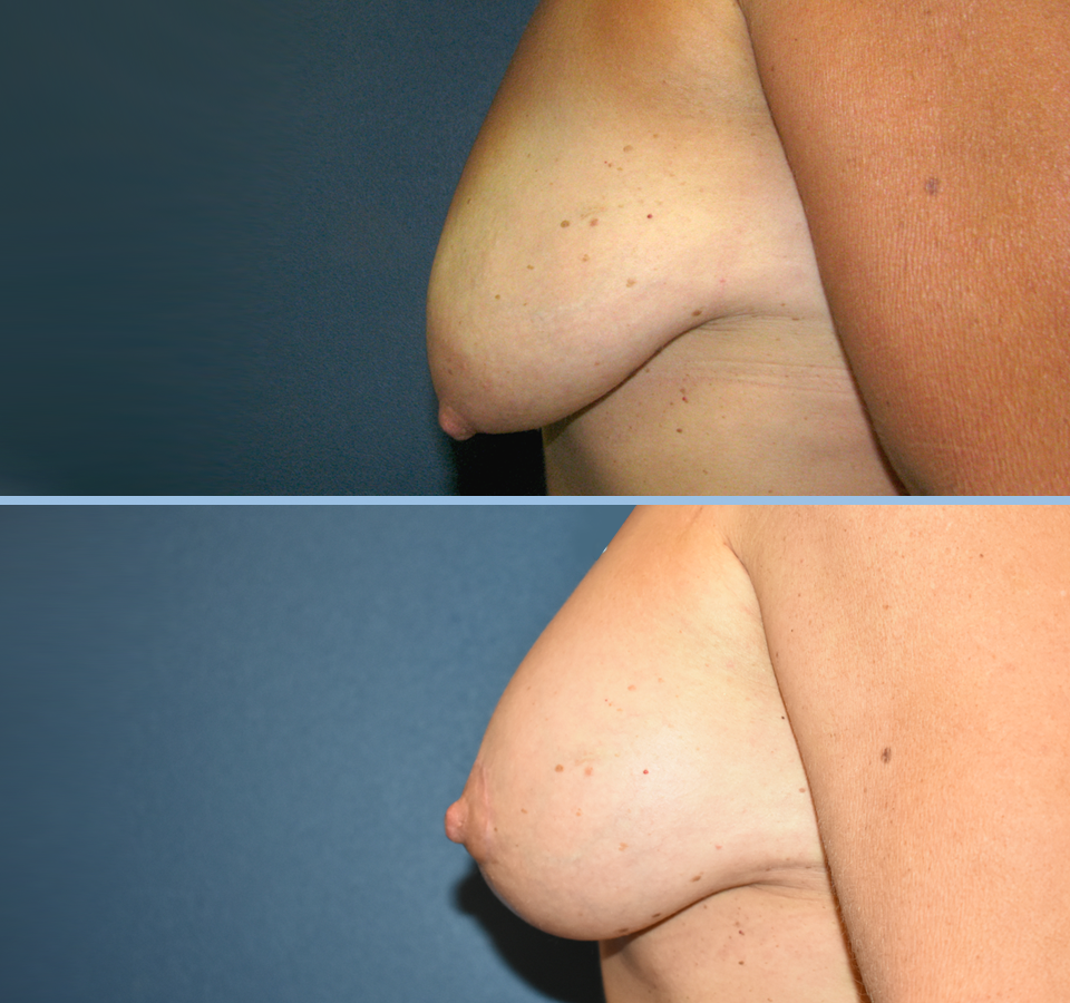 Breast Lift Patient 2 Left View