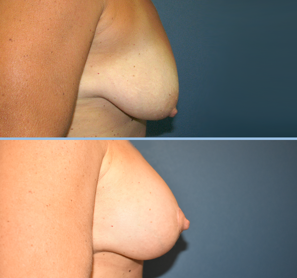 Breast Lift Patient 2 Right View