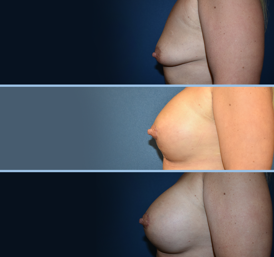 Breast Lift Patient 3 Left View