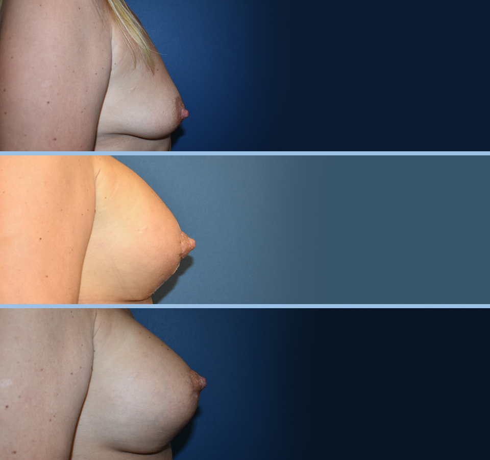 Breast Lift Patient 3 Right View