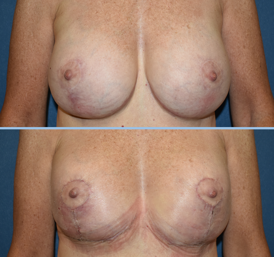 Breast Lift Patient 4 Front View