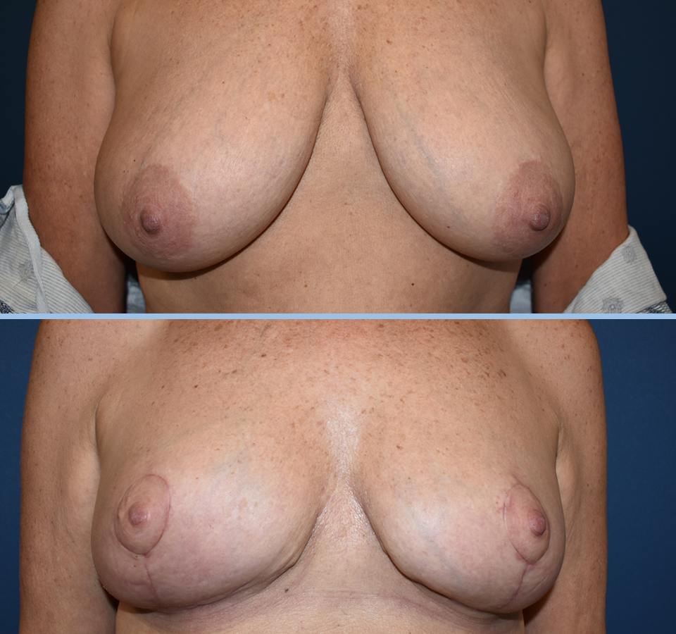 Breast Reduction Patient 1 Front View