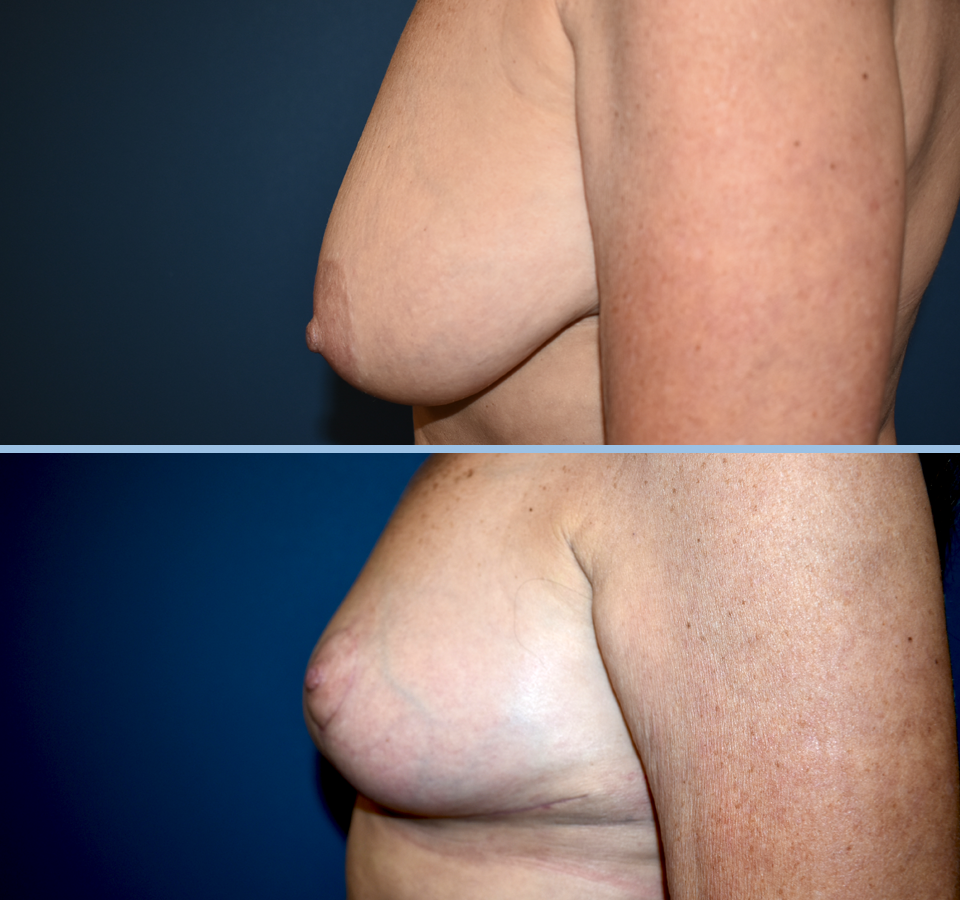 Breast Reduction Patient 1 Left View