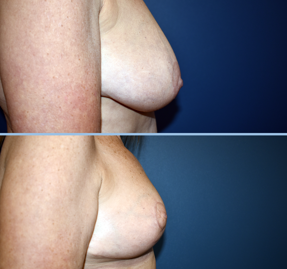 Breast Reduction Patient 1 Right View