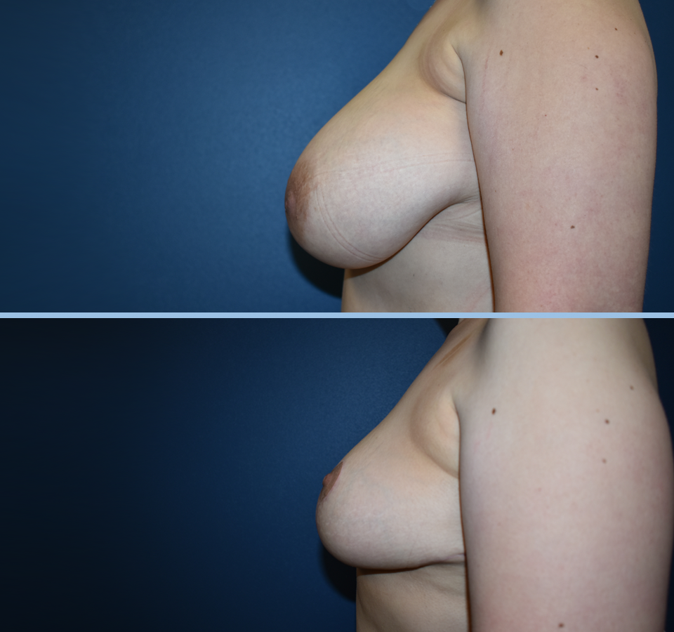 Breast Reduction Patient 2 Left View