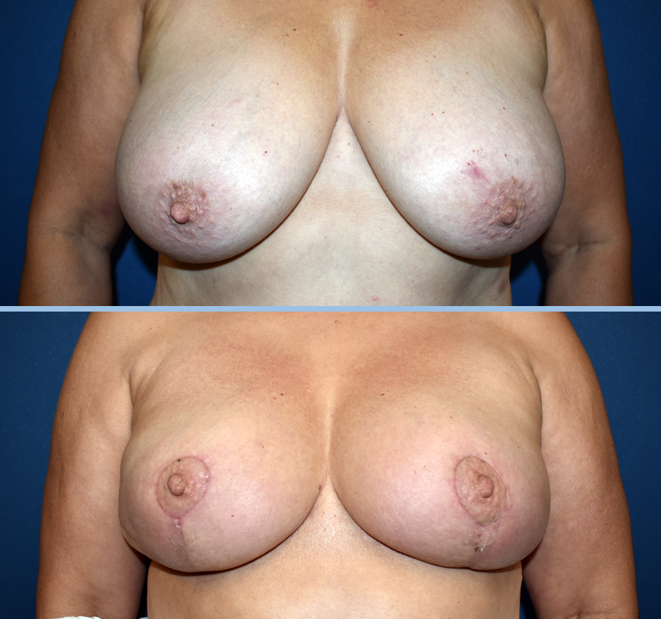 Breast Reduction Patient 3 Front View