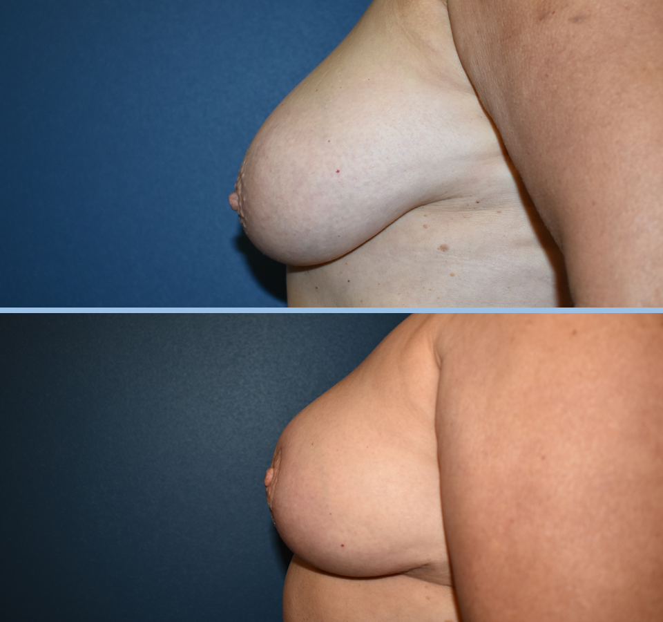 Breast Reduction Patient 3 Left View