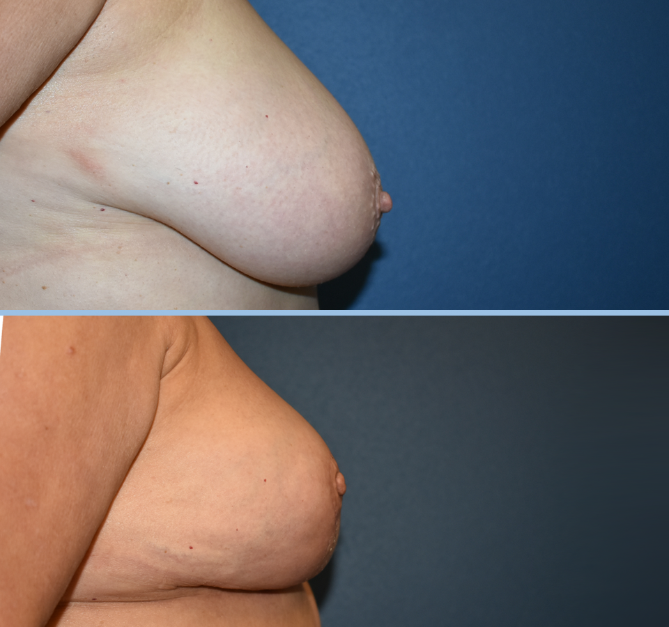 Breast Reduction Patient 3 Right View