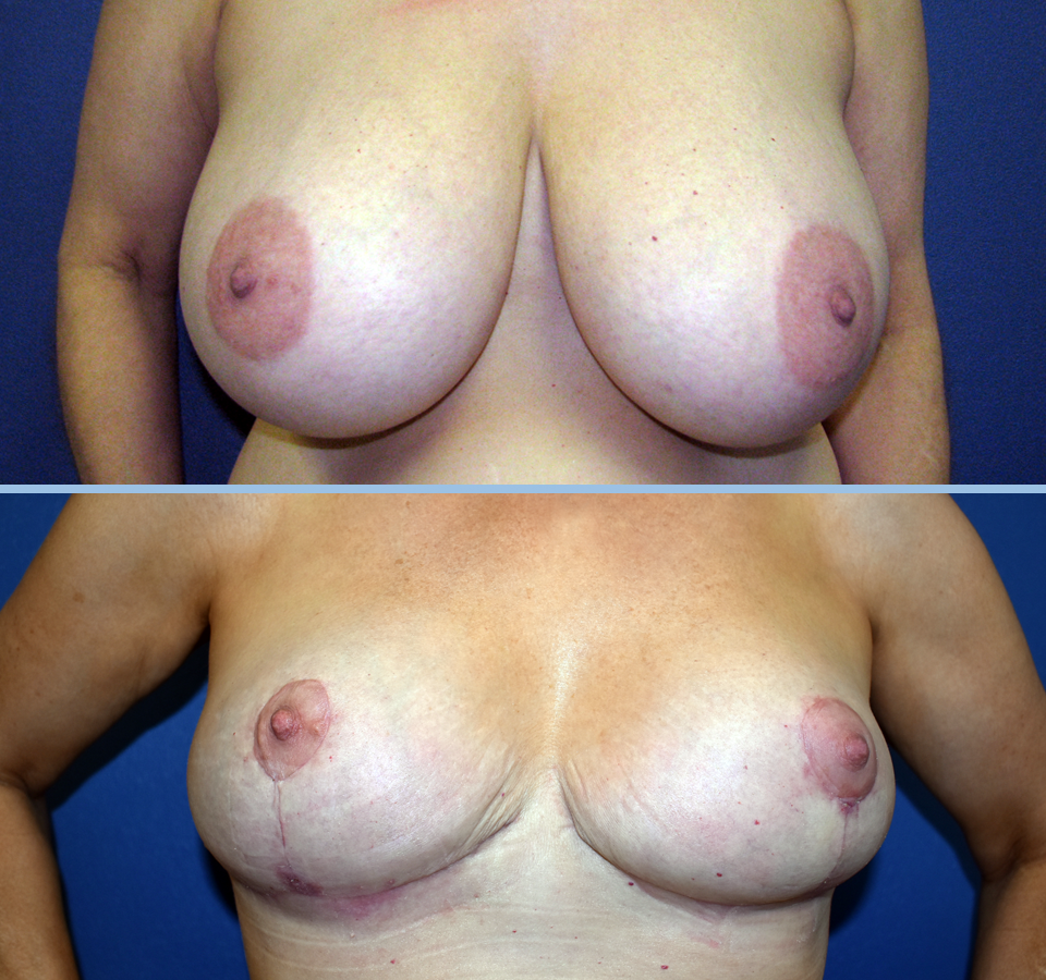 Breast Reduction Patient 4 Front View