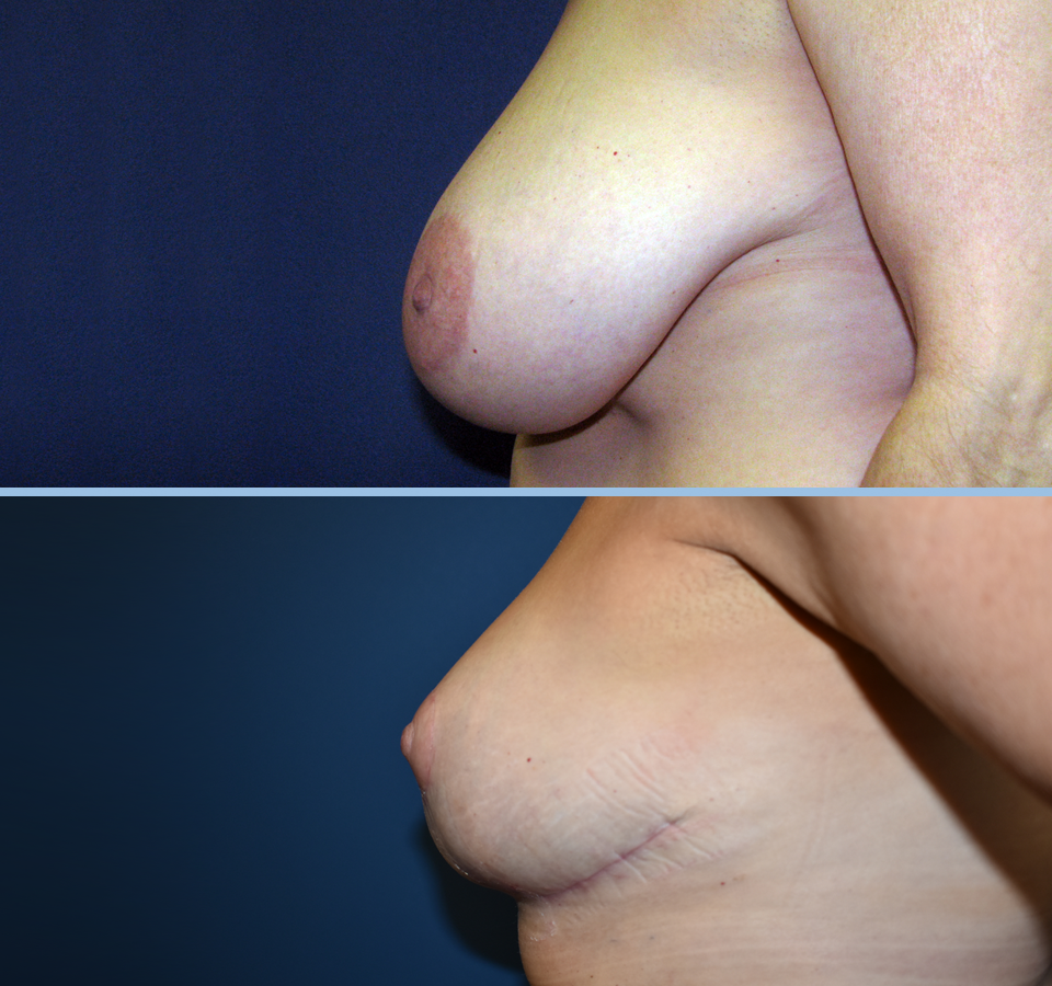 Breast Reduction Patient 4 Left View