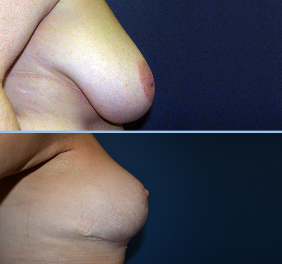Breast Reduction Patient 4 Right View